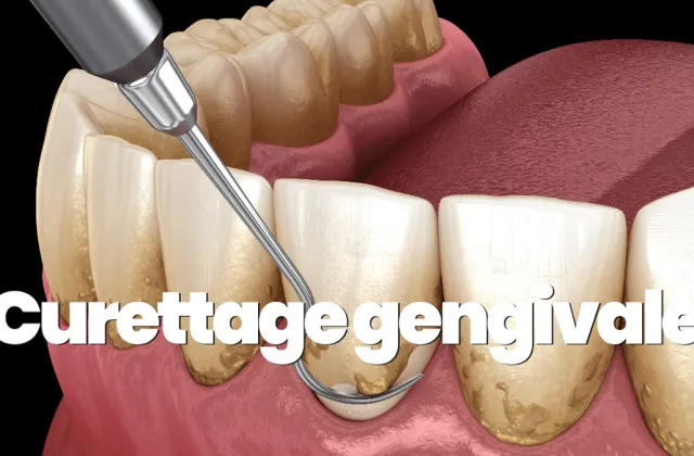 Curettage gengivale