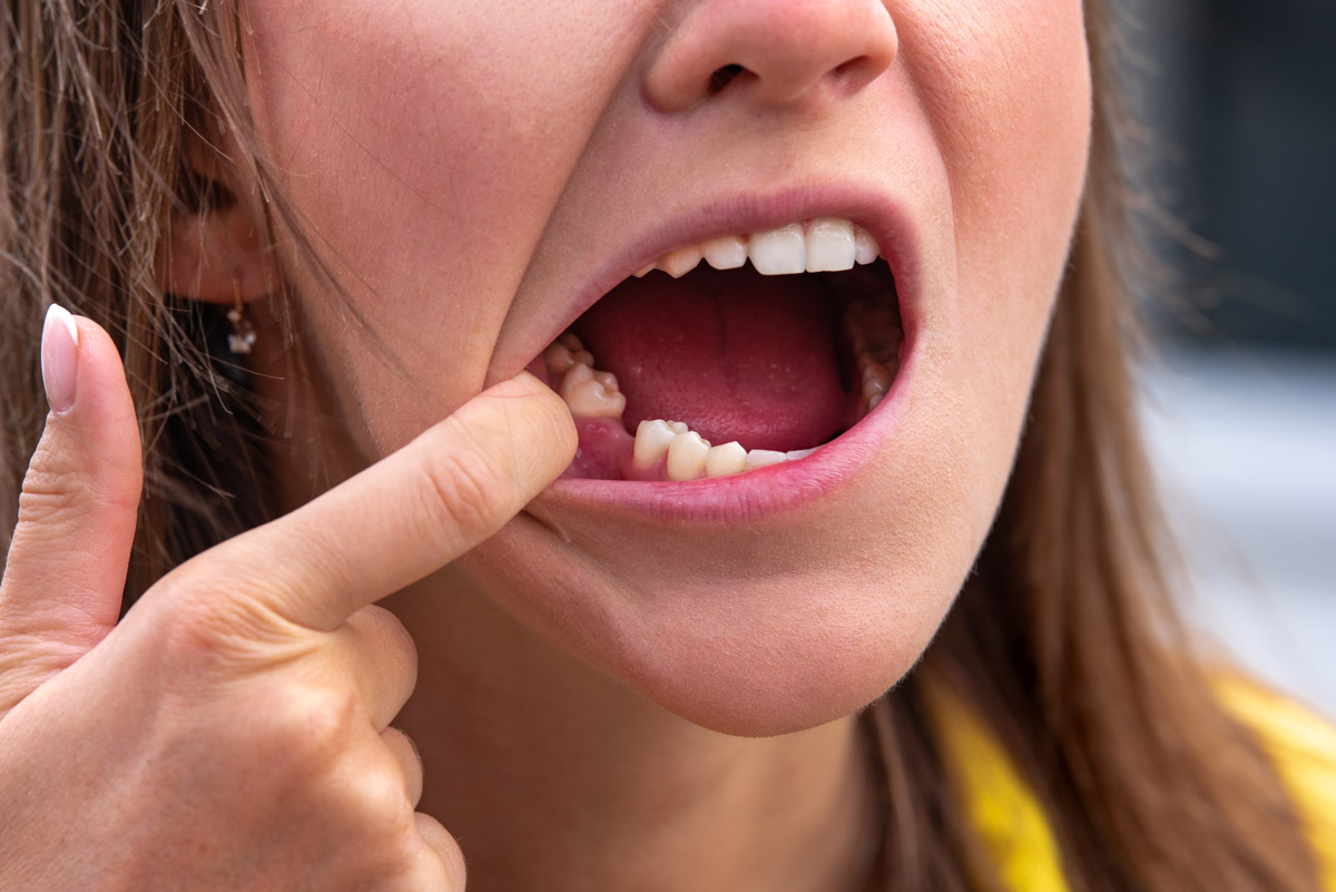 ragazza senza dente che non ha messo un impianto