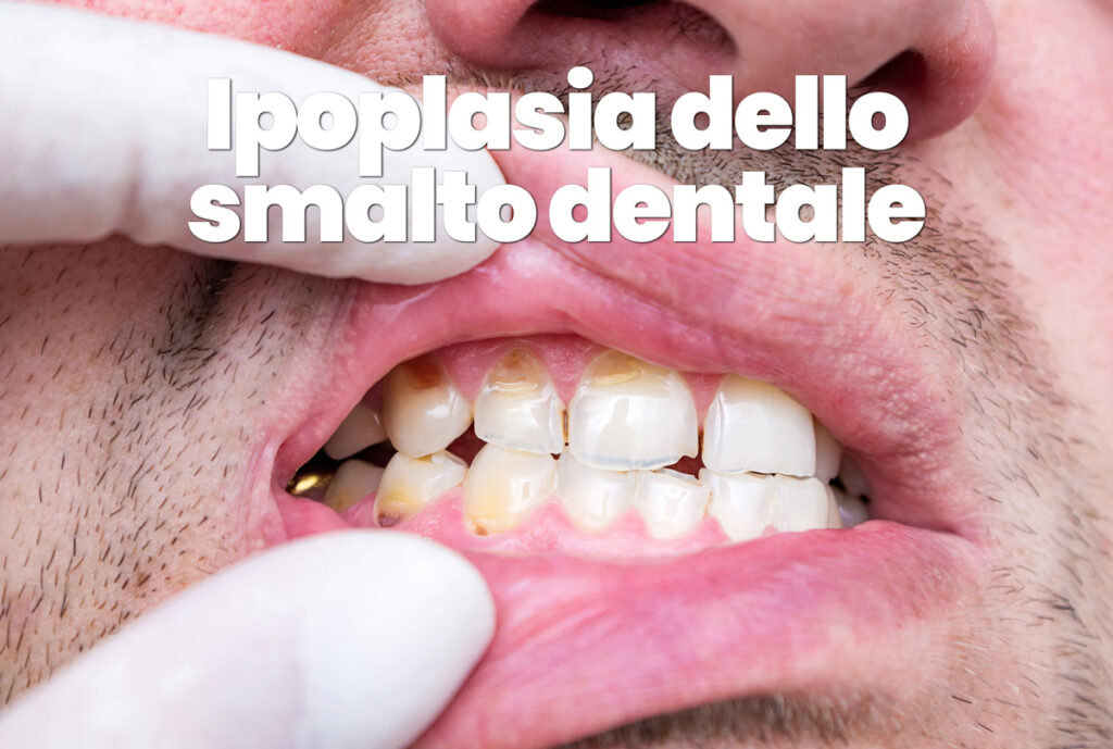 ipoplasia smalto dentale