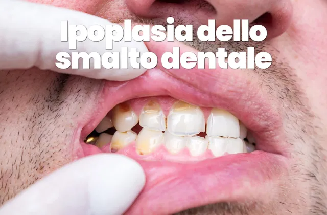 ipoplasia smalto dentale
