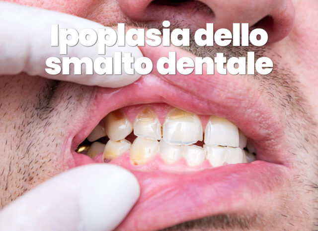 Ciuccio denti: quali danni possibili? - Dentista a Firenze - Dr