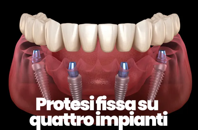 protesi fissa su quattro impianti