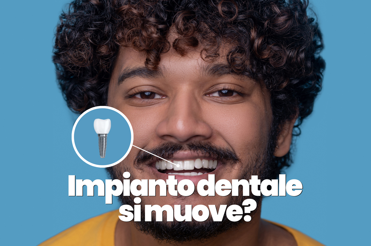 impianto dentale si muove