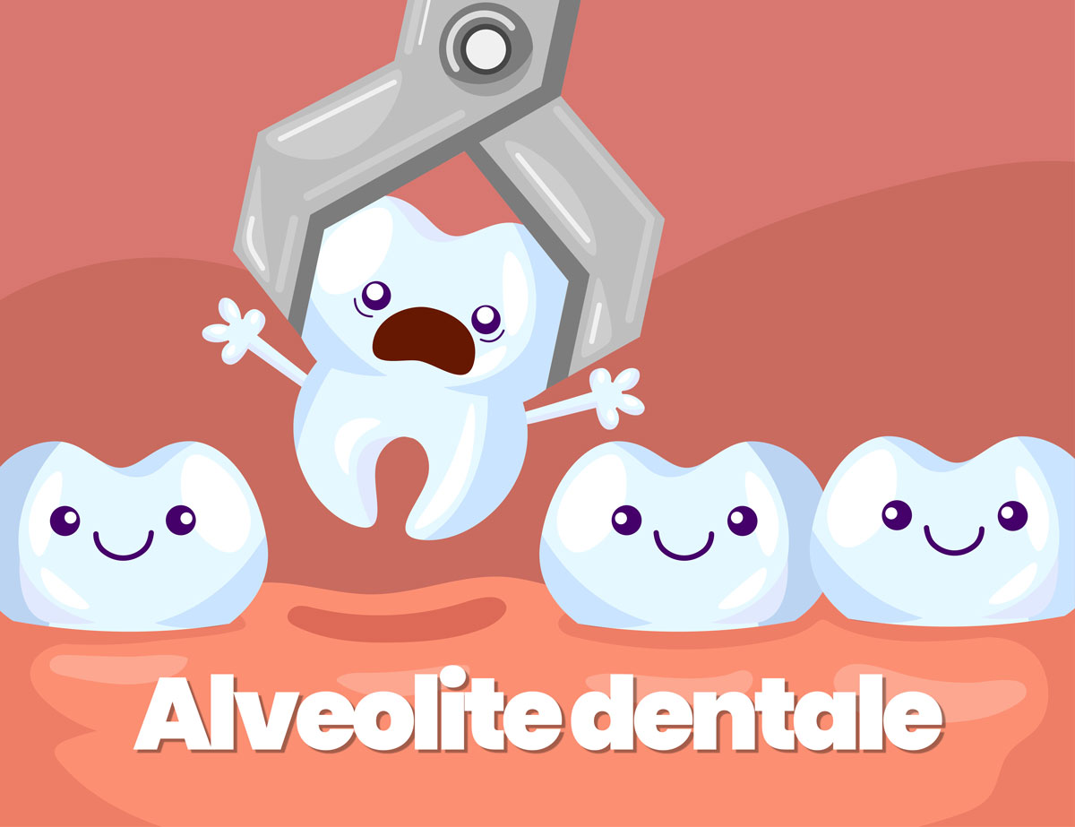 alveolite dentale