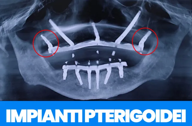 impianti pterigoidei