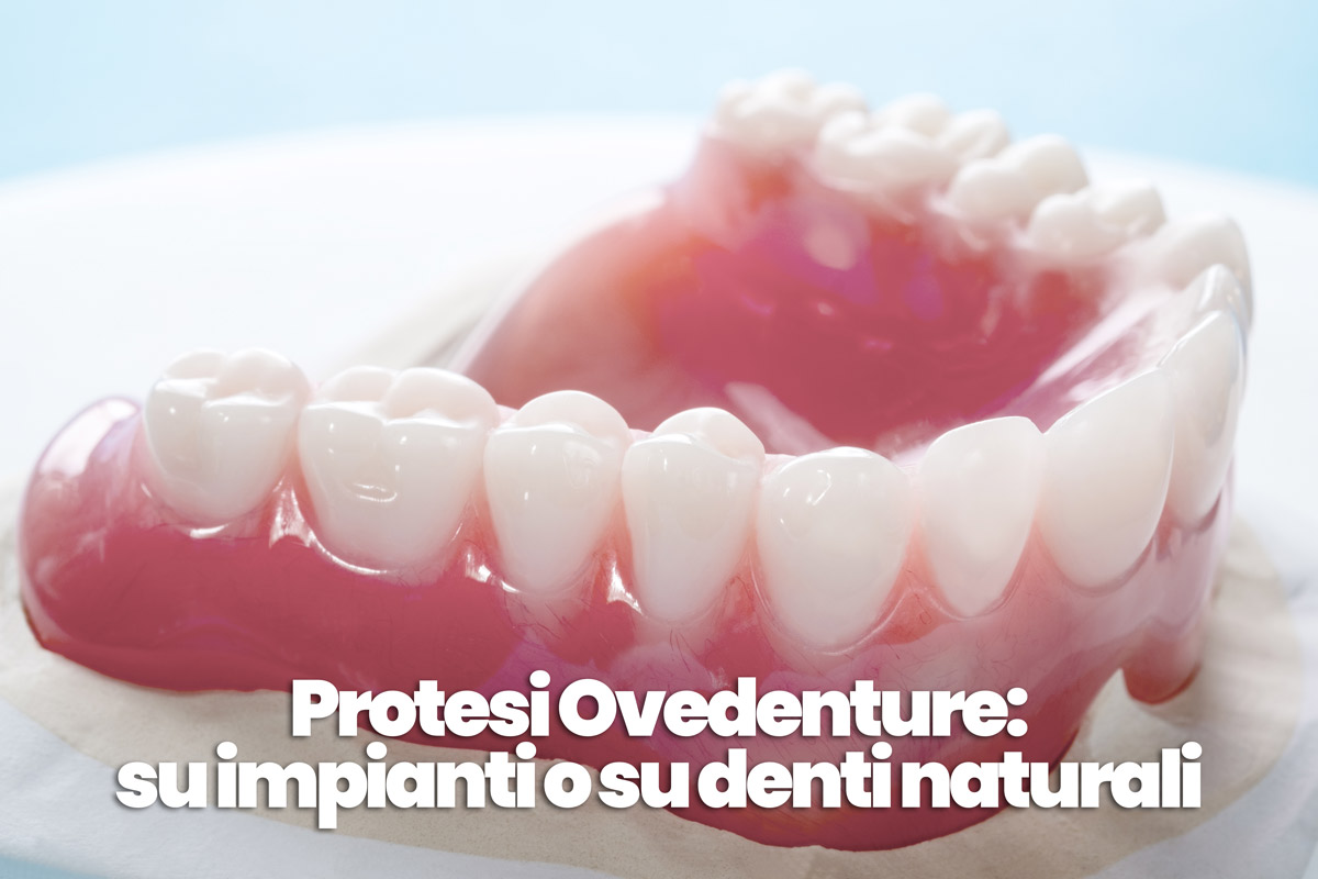 Overdenture: protesi economiche su impianti senza palato