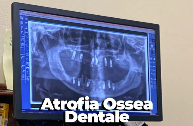 atrofia ossea dentale