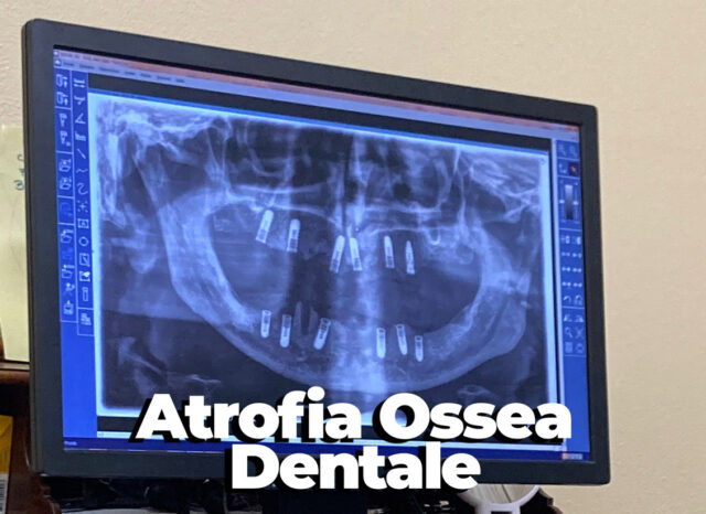 atrofia ossea dentale