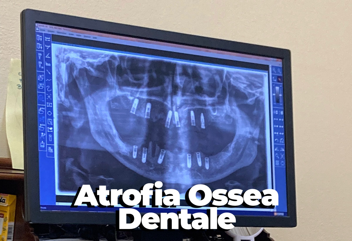 atrofia ossea dentale