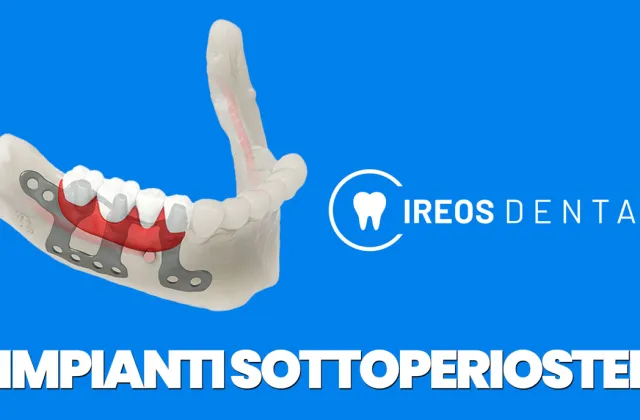 impianti sottoperiostei