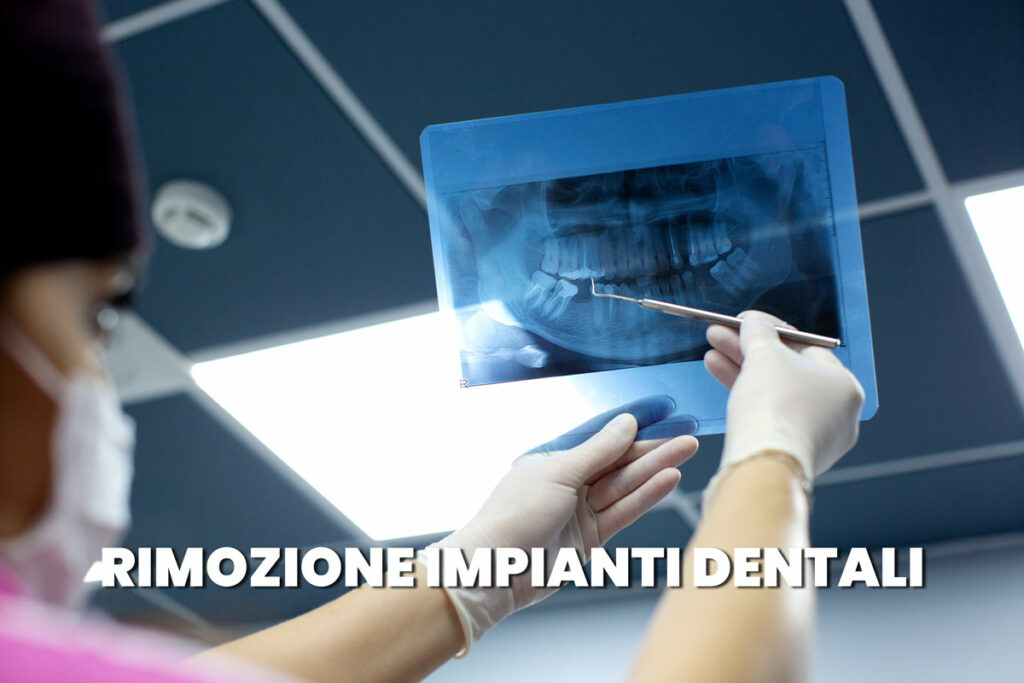 rimozione impianti dentali