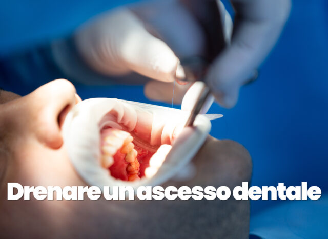 drenare ascesso dentale