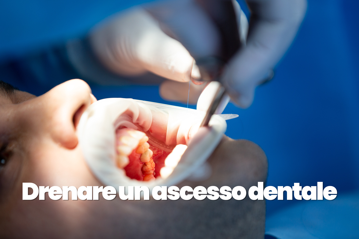 drenare ascesso dentale