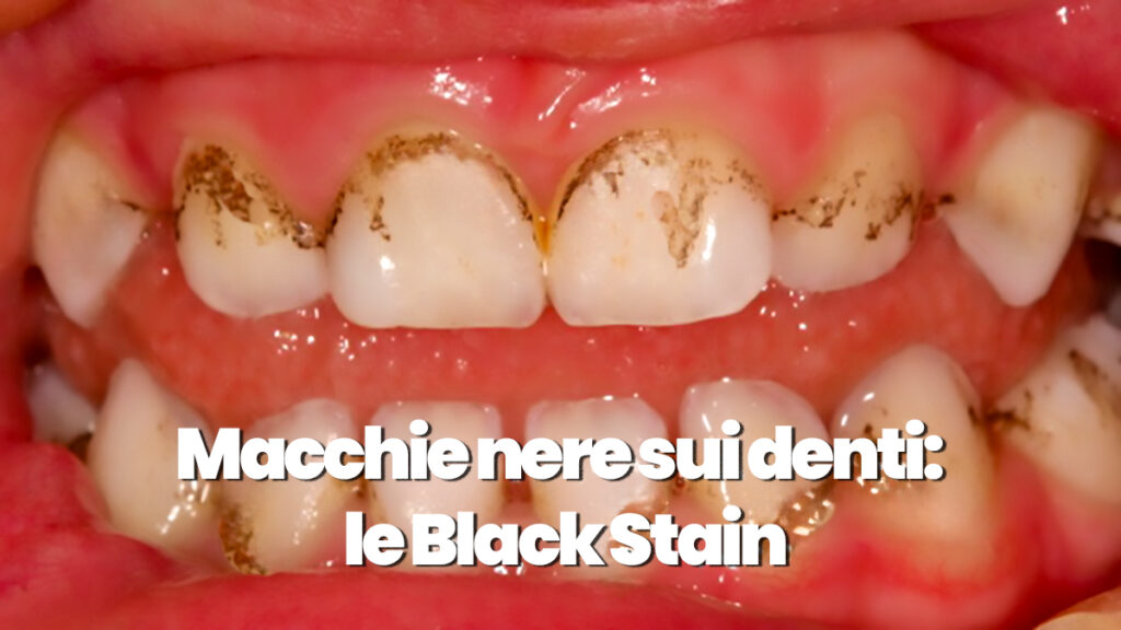 Macchie nere sui denti: Come liberarsi delle black stain