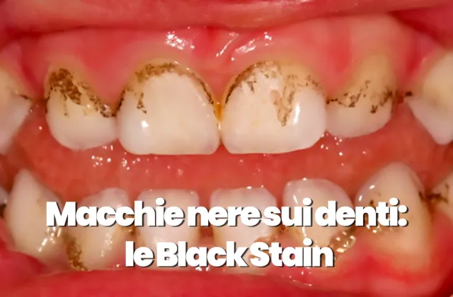 Macchie nere sui denti: Come liberarsi delle black stain
