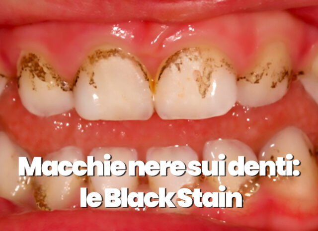 Macchie nere sui denti: Come liberarsi delle black stain