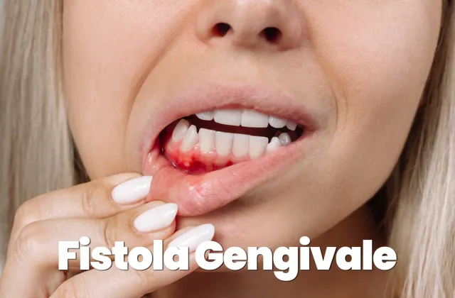 fistola gengivale