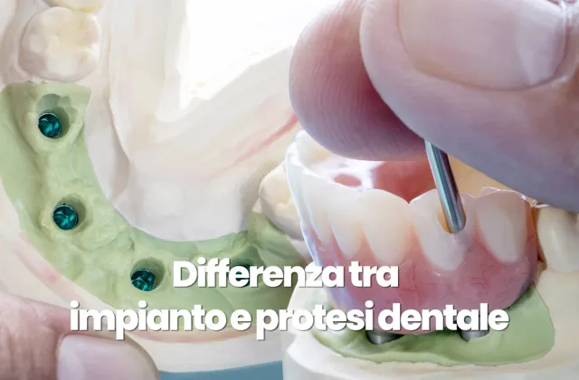 differenza tra impianti e protesi dentali