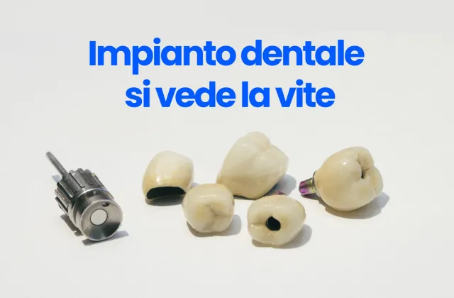 impianto dentale si vede la vite