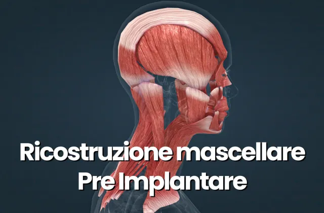 ricostruzione mascellare per impianti dentali