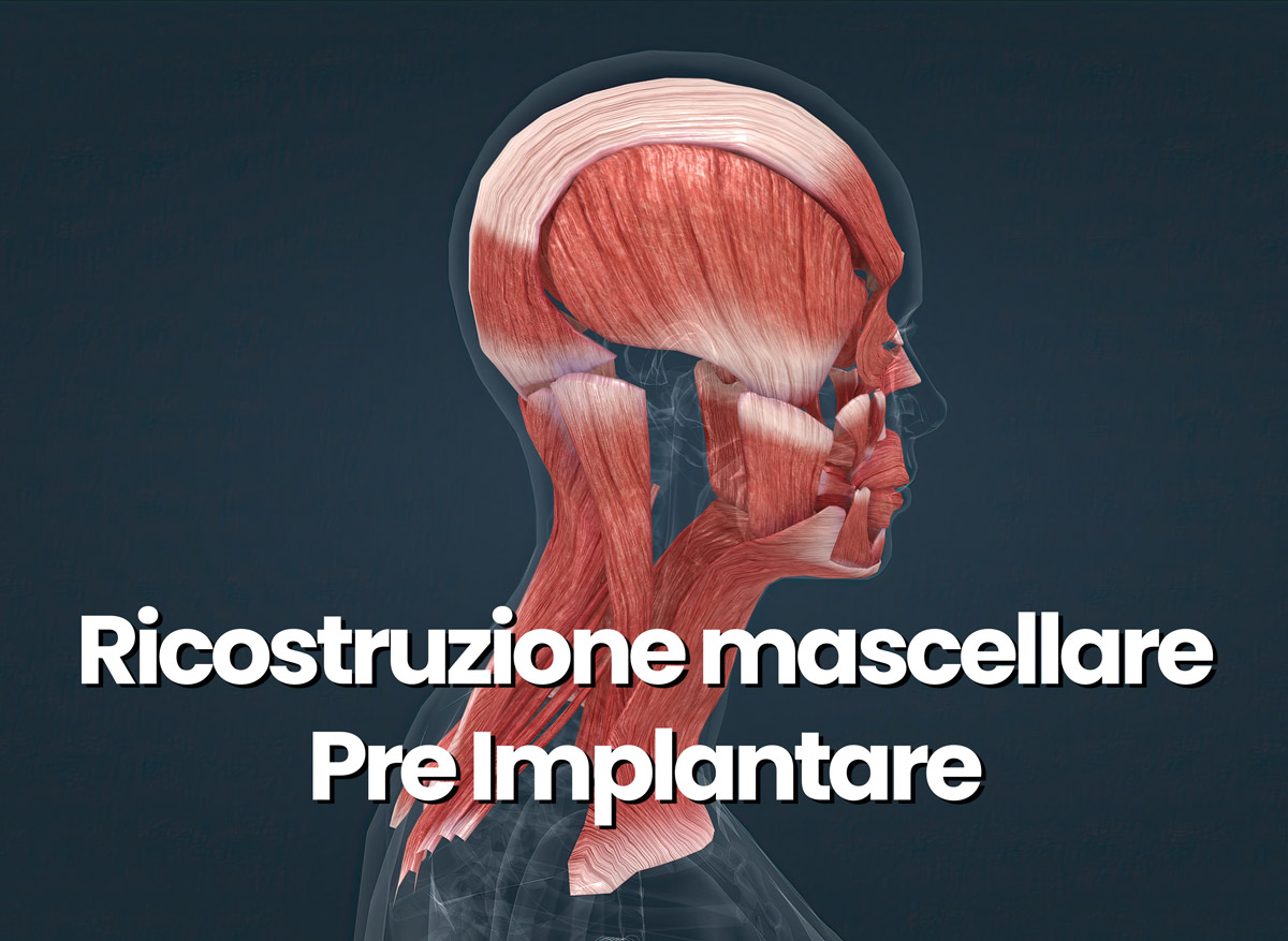 ricostruzione mascellare per impianti dentali