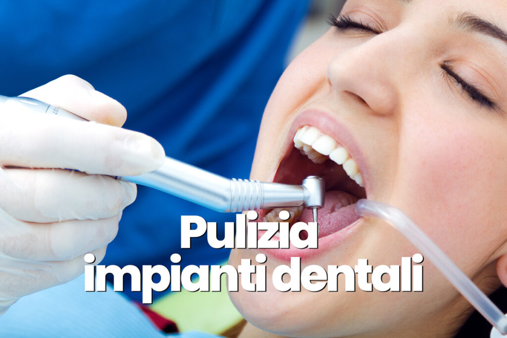 pulizia impianti dentali